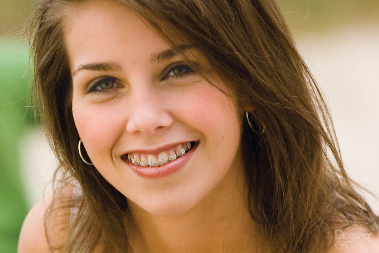 Ceramic braces on a young girl