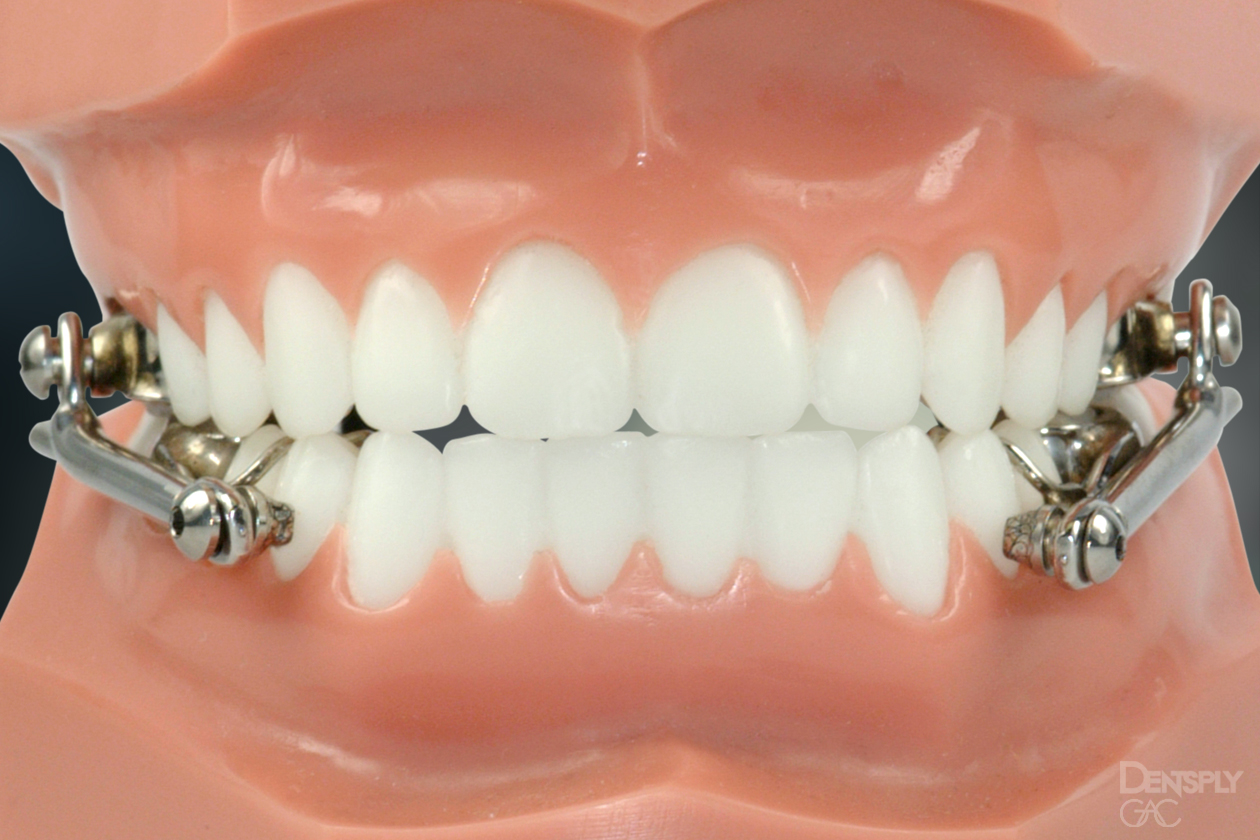 Ceramic braces on a young girl