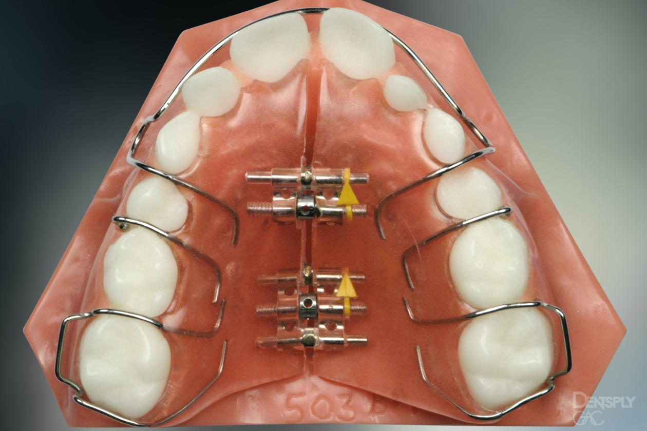 Demonstrates a removable appliance with midline screws to widen the upper teeth.