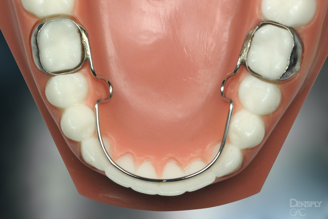 Shows a lingual arch on a model of teeth.