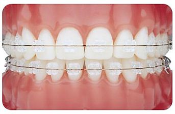 Clear fixed ceramic braces
